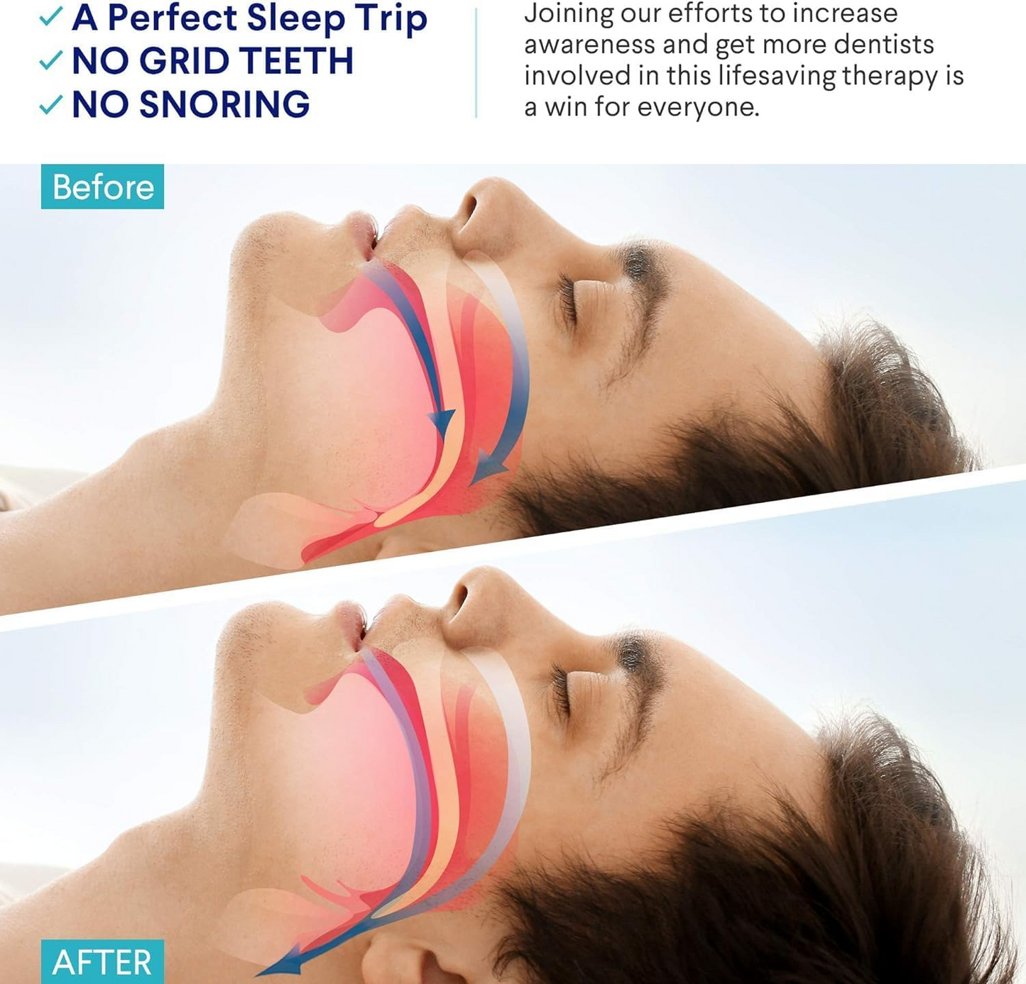 Anti-Snoring Mouthpiece